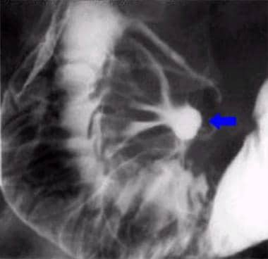 duodenal ulcer x ray