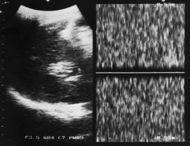 Sagittal oblique sonogram of the liver shows sever