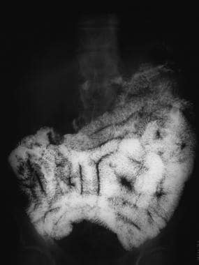 Sprue. Radiograph from a small-bowel series in a p