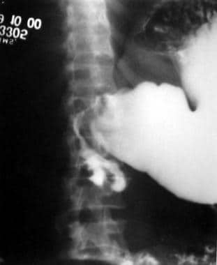 Barium examination reveals a long stricture of the