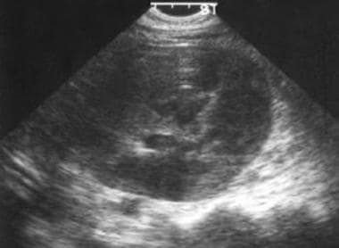 Axial sonogram in a 22-year-old woman with known l