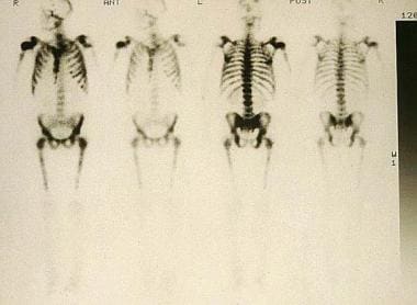 Isotopic bone scans. Diffuse metastases demonstrat