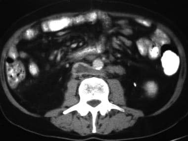 CT reveals thrombus extending from the left renal 
