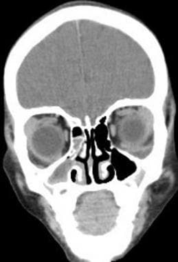Coronal computed tomography scan in a patient with