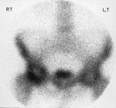 Radionuclide bone scan of the pelvis in a 68-year-