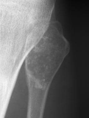 chondroma in knee x ray