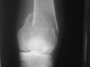Anteroposterior radiograph of the knee shows a pat