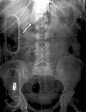 Thoracic spine trauma. Anteroposterior view radiog