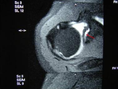 An anterior labral tear extends into the superior 