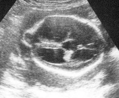Sagittal ultrasonogram through the fetal skull sho