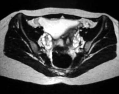 Axial T2-weighted magnetic resonance image of the 