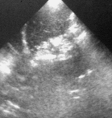Left coronal ultrasonogram obtained along the grea