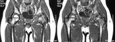 Legg-Calvé-Perthes disease. Coronal T1-weighted MR