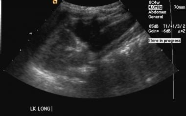 Longitudinal sonogram of the left kidney in a pati