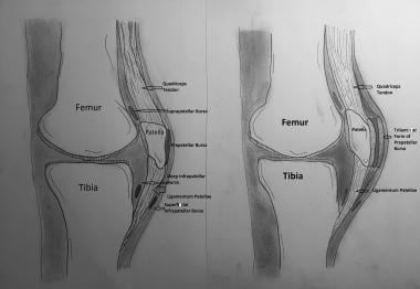 Bursectomy knee complications