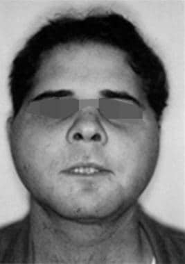 LeFort III fracture showing facial flattening, wid