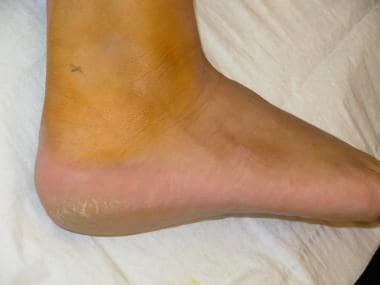 Marked site adjacent to the Achilles tendon. 