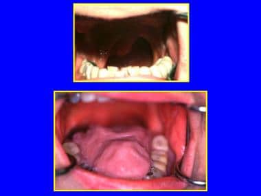 Total glossectomy with an artificial tongue for sp
