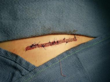 Running suture line. 