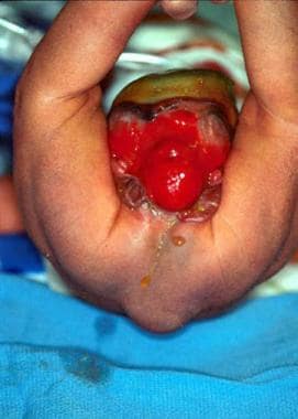 Lipomeningocele在相同的新生儿中显示