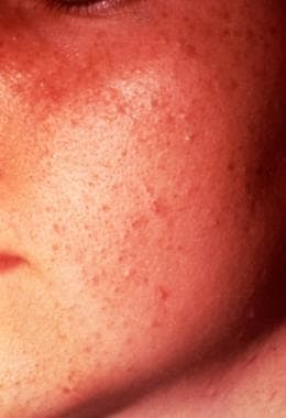 mild acne vulgaris