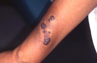 A 44-year-old woman with plaque on her forearm sin