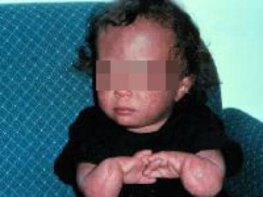 rothmund thomson syndrome