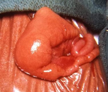 Intestinal obstruction in the newborn. Operative p