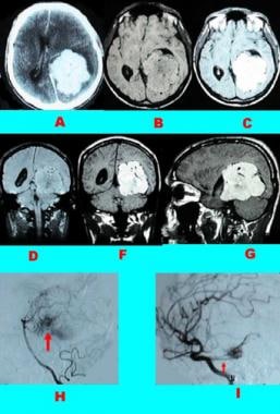 Case 3: Tentorial meningioma. A, Contrast-enhanced