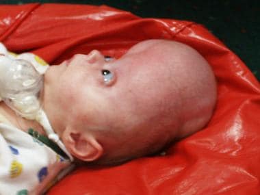 Infant with primary craniosynostosis. The specific