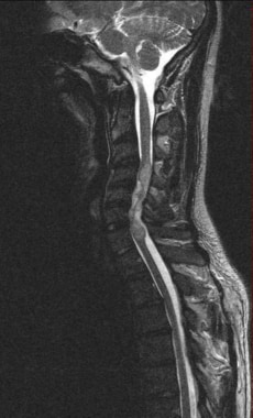 MRI image of the sagittal neck with an ependymoma.