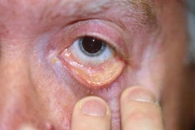 Lower lid trachoma with cicatrix. 