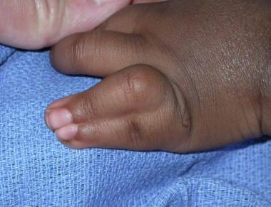 Deformities of Fingers and Toes in the Newborn