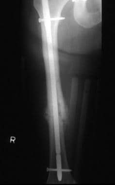 Midshaft femur fracture managed with open reductio