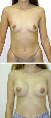 (Above) Preoperative view of 28-year-old woman wit