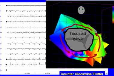 Typical counterclockwise atrial flutter. This 3-di