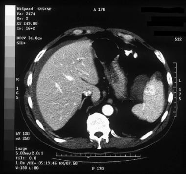 Splenic infarct. Computed tomography scan of a 51-