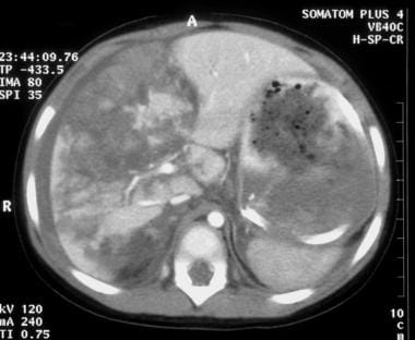 Computed tomography (CT) image of grade V liver la
