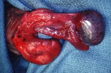 Intraoperative findings in testicular torsion. 