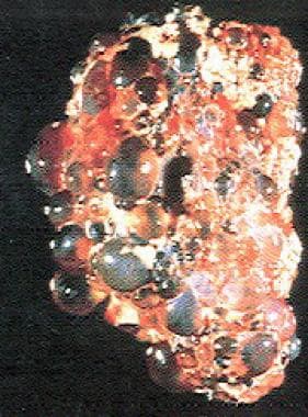 Polycystic kidney. 