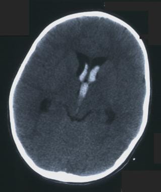 CT scan without contrast in the patient with fourt