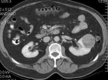 Typical renal cell carcinoma. CT scan obtained bef