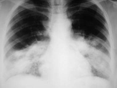 Bacterial Pneumonia: Practice Essentials, Background, Pathophysiology