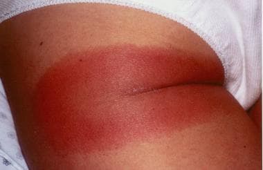 a) Day 1, patient presents with flat erythematous rash with scattered