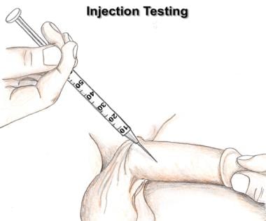 Hogyan kell beadni egy pénisz injekciót Merevedési zavarok diagnózisa és kezelése