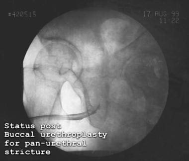 Urethral strictures. Retrograde urethrogram demons