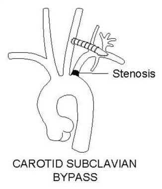 Carotid-subclavian bypass. 
