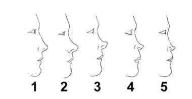 Saddle-nose classification based on anatomic defic