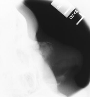 Lateral radiographic view of a nasal bone fracture