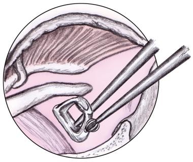 Stapedotomy Animation to Treat Otosclerosis (Curable Type of